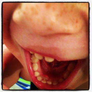 wiggly wobbly tooth with 'adult' tooth behind!